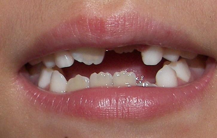 7岁儿童换牙,新门牙顶部长成奇怪的三个小齿,有5颗都已经这样了