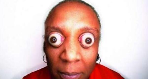 世界上眼球最突出的女人金古德曼眼睛凸出11毫米