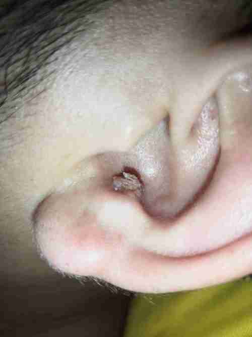耳朵里面从小就长有一个疙瘩,激光后又长出来了