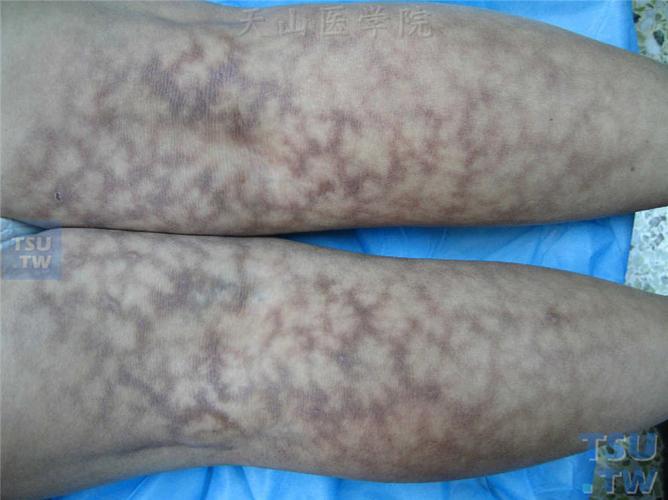 下肢屈侧皮肤对称性网状青紫色斑纹,斑纹间皮肤正常或苍白,呈大理石样