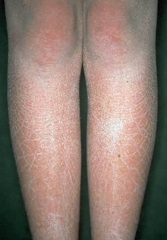 鱼鳞病是一种遗传性角化障碍性皮肤病能根治吗