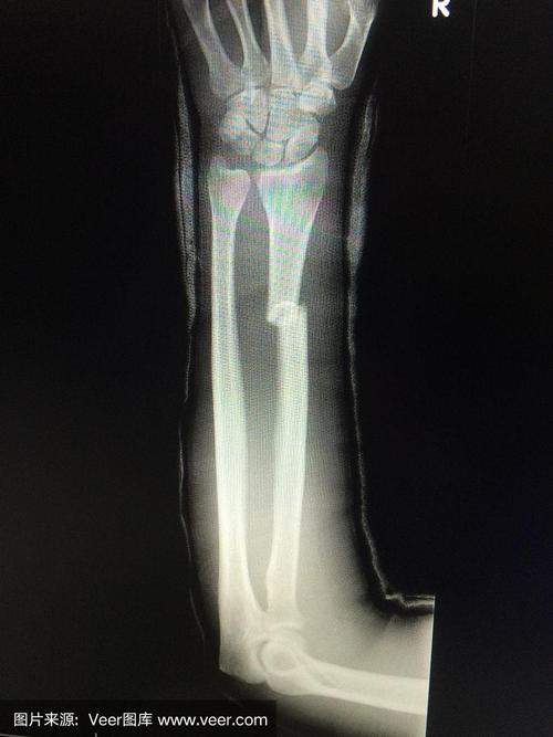 桡骨骨折的人手臂x线照片