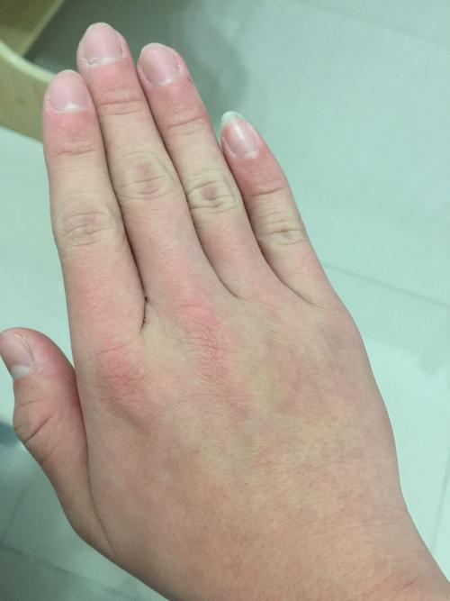 手指发紫发红 偶尔还有惨白.就近一个月才出现的 请问这是怎么回事啊!