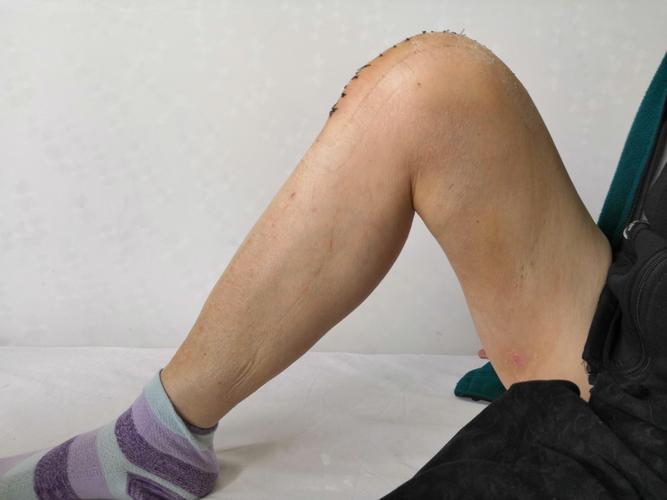 银川市第二人民医院成功完成一例膝关节外翻合并屈曲挛缩畸形病人全膝
