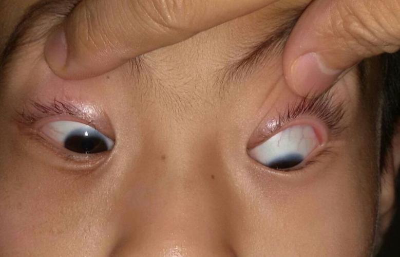 极易漏诊的儿童眼眶骨折--眼眶病系列之二