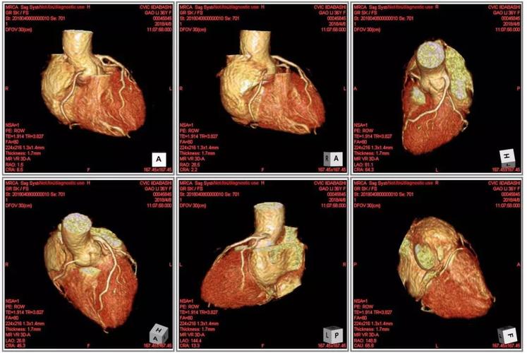 心脏核磁影像诊断技术通过建立心脏3d模型,预见心脏疾病,避免心梗等