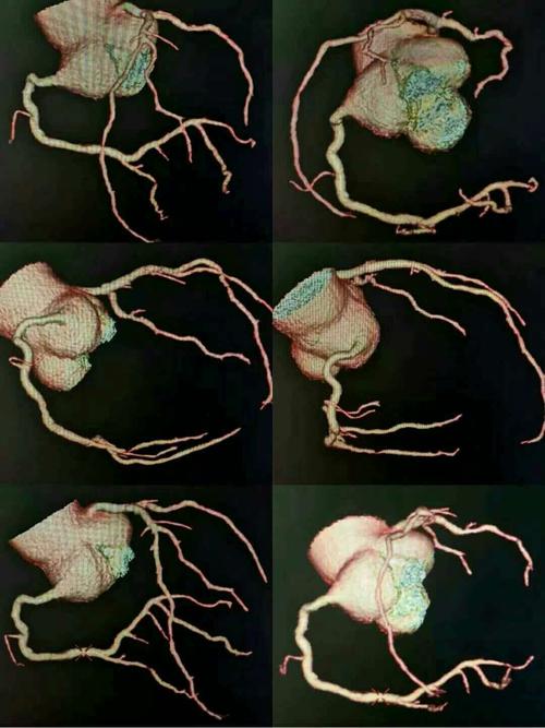 真正意义上的三维成像,可以任意角度旋转观察各支血管的走形及狭窄