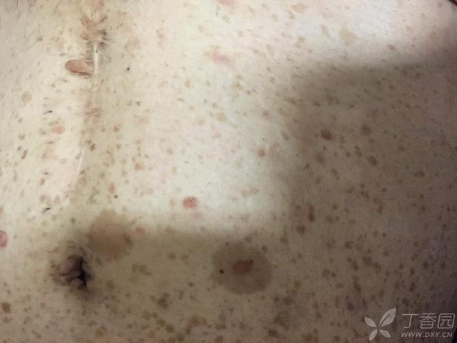 帖子详情 分享两例i型神经纤维瘤病患者皮肤照片-传说中的牛奶咖啡斑