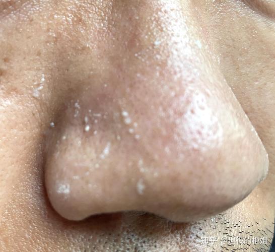 下图就是典型的黑头:典型的黑头鼻,鼻子毛孔里有一颗颗油脂颗粒堵