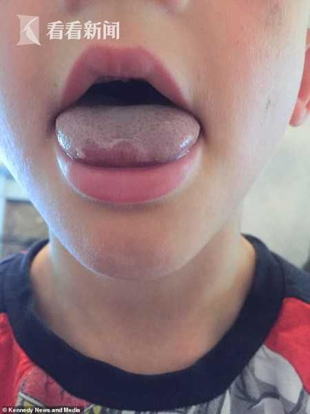 6岁男童狂吸水壶口舌头被卡坏死 医生用电锯切开