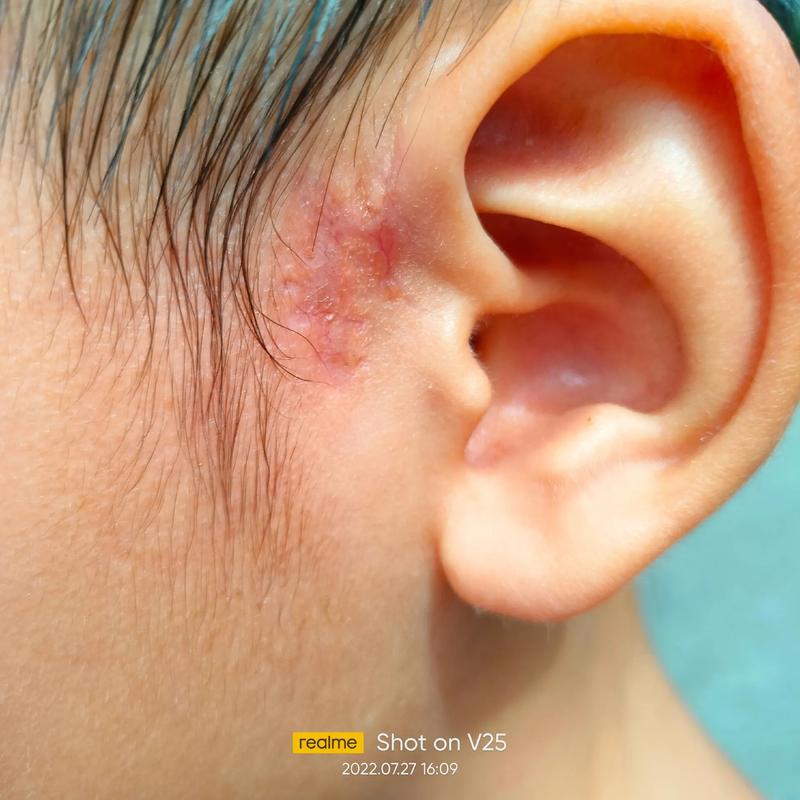 抖音的老铁们谁知道耳前瘘管术后多久可以做皮肤激光求告知