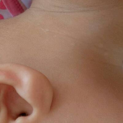 宝九个月,最近发现脖子左侧起了几个特别小特别小的小白点点,我想知道