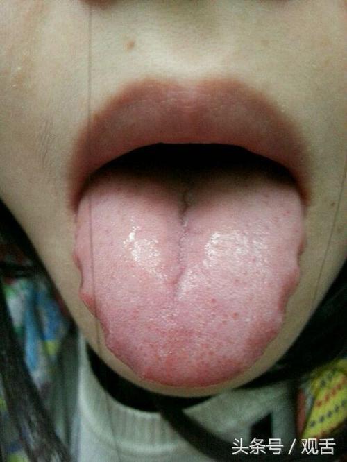 舌诊阳虚体寒肝阳上亢肝脾不和血瘀肝郁的舌苔照