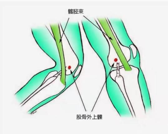 髂胫束摩擦综合征"和"股骨外上髁炎",是膝关节外侧疼痛的主要原因之一