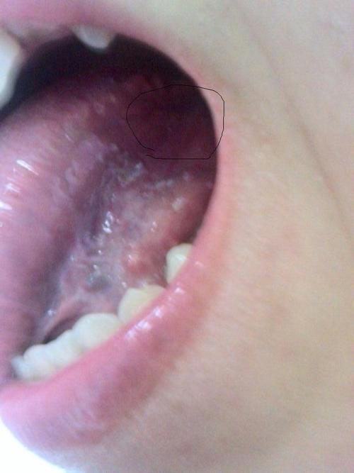 想得到什么帮助:舌根处的血丝,正常么曾经的治疗情况:我想知道舌根靠