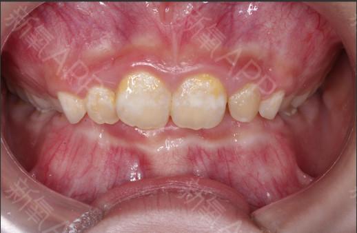 咬下唇的习惯导致前牙咬合时完全看不见下牙