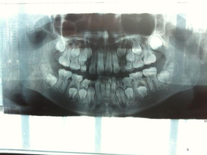 诊断-----牙齿x光片