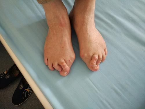 男子多个脚趾手指外翻畸形 类风湿性关节炎是"幕后黑手"