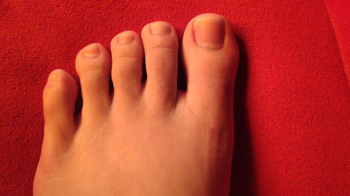 大脚趾一按指甲就疼是怎么回事「大脚趾指甲有一道黑色竖纹」-友友