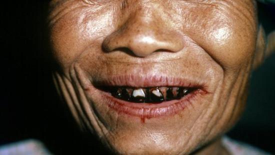 来自湖南的谭先生因常年嚼槟榔,罹患口腔癌,成为"割脸人"在我国