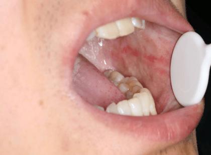 口腔科普慎点某人经常吃槟榔这是他的口腔黏膜发生的变化