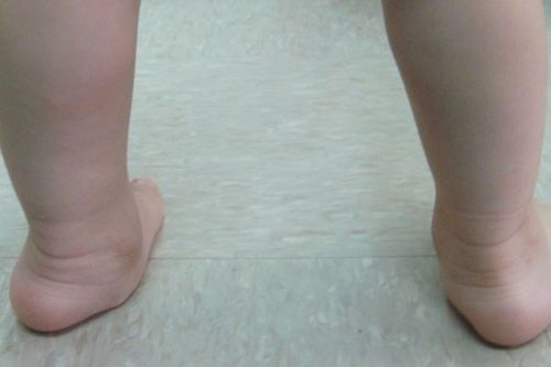 扁平足↑ 从小腿肚垂直地面划一条线,脚后跟骨会外翻,脚板内侧