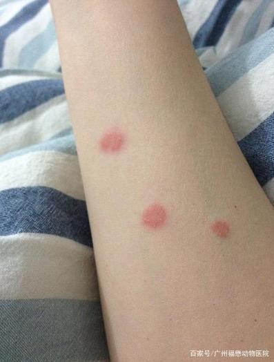 会将癣传给人或其他动物 人的皮肤上会出现红色皮疹 症状是红色