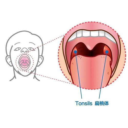我们常吐槽的"发炎君"——扁桃体,指的是位于舌顎弓和咽顎弓腭之间的