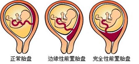 早中孕期发现胎盘位置低/胎盘低置怎么办?还有机会顺产吗?