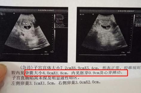 怀孕5-8周,从"小海马"到胎儿变化大,4点特别注意孕妈牢记