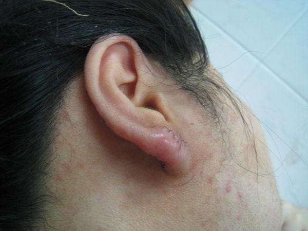 打耳洞后--疤痕疙瘩的手术治疗