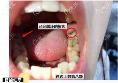 1,智齿蛀牙智齿出现比较深的蛀牙,或位置不正,窝洞发生在牙齿邻面