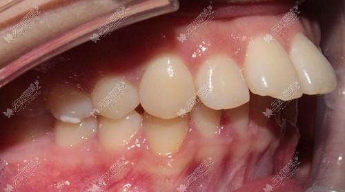 门牙龅牙医生建议磨小戴牙套矫正可磨小的牙寿命会变短吗