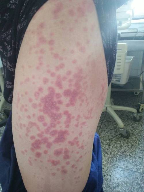 博莱霉素罕见过敏皮疹多形红斑