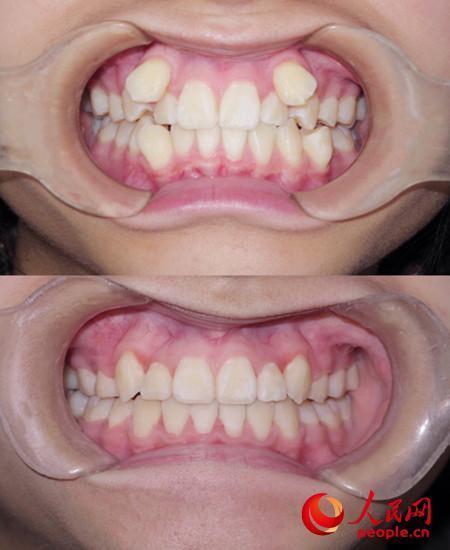 拔虎牙或致变老变丑 牙齿正畸是治疗最佳方式