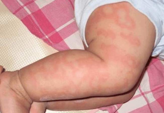 婴儿出现红疹该怎么办?一份实用指南