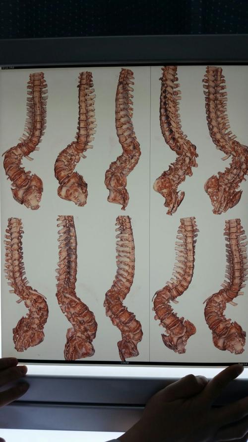 3d打印技术在重度脊柱畸形合并完全截瘫患者手术中的应
