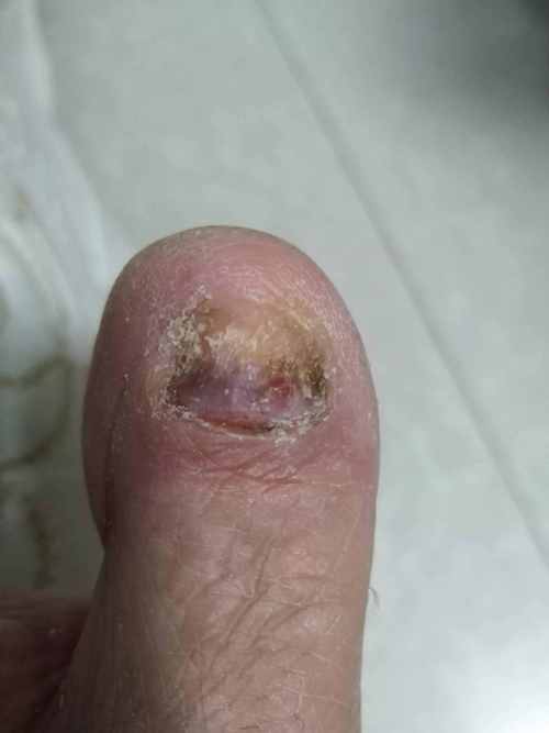 灰指甲怎么治疗灰指甲刚开始的图片