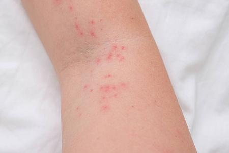 女性手臂上的皮疹,过敏反应引起的瘙痒丘疹,反应,过敏概念和皮肤病学
