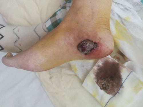 足部黑色素瘤,高度恶性广泛切除肿瘤,皮瓣覆盖