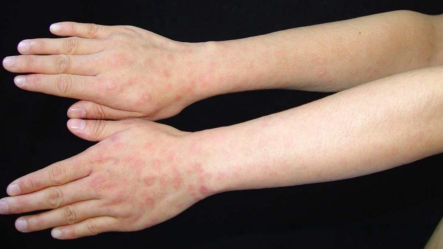 上肢外侧斑疹性二期梅毒疹图片