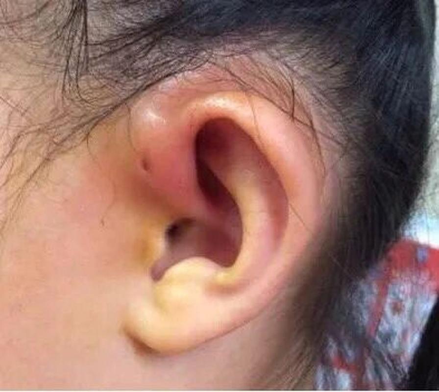 宝宝耳朵上面的小孔叫"仓眼"先天性耳前瘘管 有的人耳朵上面有一个