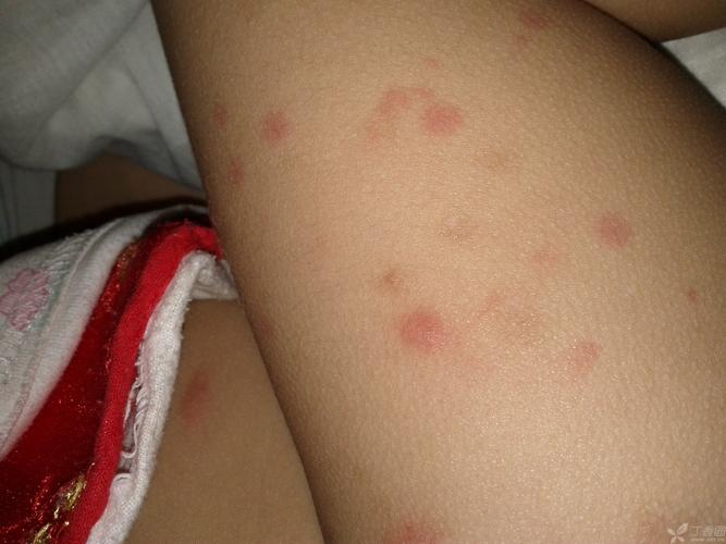 【求助】求助,儿童皮肤反复出现红色瘙痒疹子