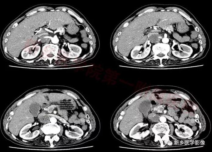 【病例】腹膜后嗜铬细胞瘤1例ct影像表现