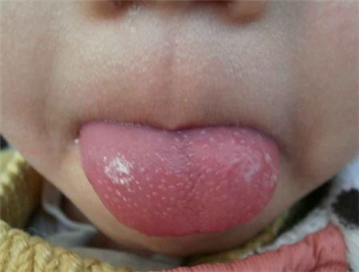 小孩草莓舌是怎么回事