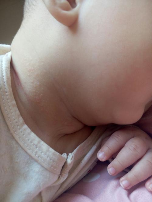 宝宝脖子里这疙瘩没事吧 是热的嘛 还是吐奶吐的