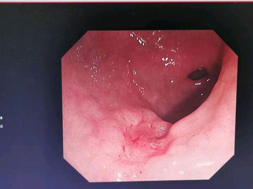 进展期胃癌胃镜图像