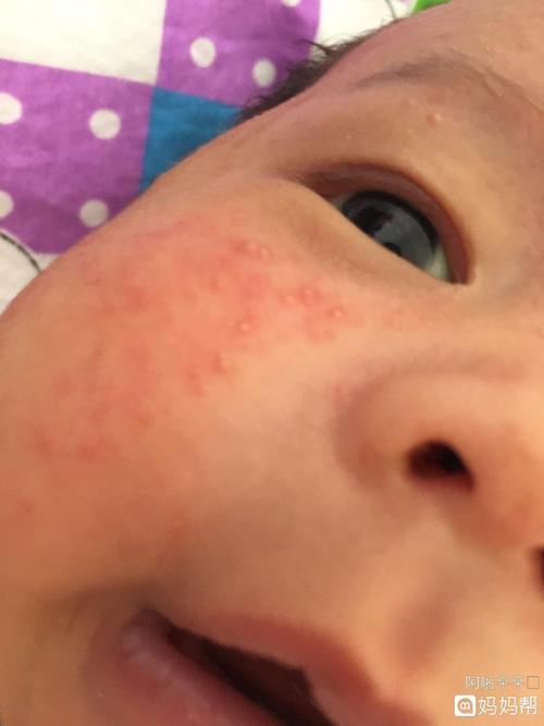 妈妈遇到婴儿湿疹不要慌乱,婴儿湿疹的治疗方法,要从日常护理着手