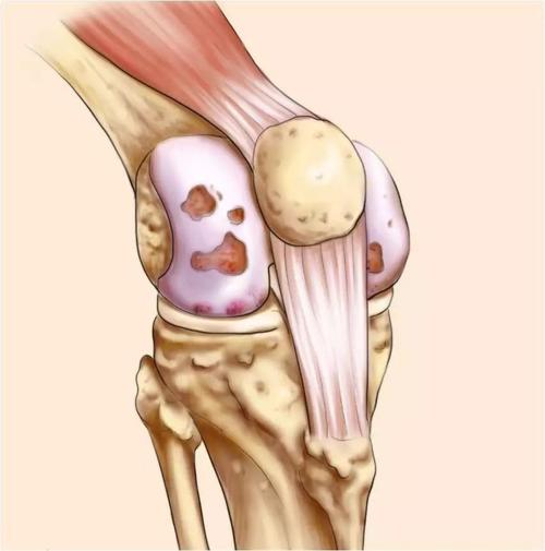 如图所示,正常膝关节的关节软骨光滑有弹性.
