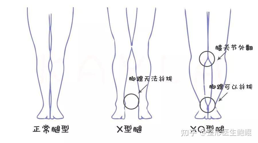 x型腿就是 膝外翻,当你站立的时候,膝盖可以并拢,但是脚踝不能并拢